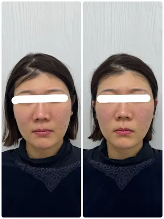 美容鍼×小顔矯正 ×美容整体　浜川泰仁のエステ・リラクイメージ