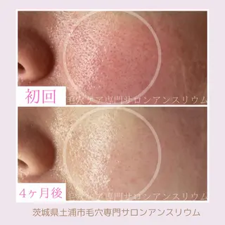 毛穴ケア専門サロンアンスリウム所属・茨城土浦 つくば毛穴 ケア専門サロンのエステ・リラクイメージ