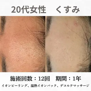 重度ニキビ専門🌷 ダウンタイムなしのエステ・リラクイメージ