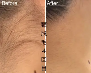 肌管理脱毛ピーリング CDFAkasakaのエステ・リラクイメージ