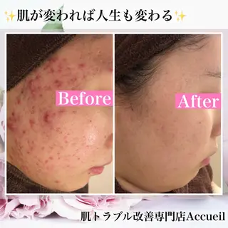 ミディアム カラー パーマ ヘアアレンジ メンズ キッズ ネイル マツエク・マツパ アイブロウ ニキビ・肌質改善専門 ♡人生が変わるサロンのエステ・リラクイメージ