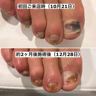 ネイル Mellow nail所属・巻爪無料モデル募集 ✨🦶MEGUMIのネイルデザイン