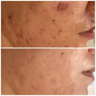 カラー パーマ ヘアアレンジ キッズ マツエク・マツパ アイブロウ 🔥3か月で肌革命 🔥ニキビ専門店のエステ・リラクイメージ