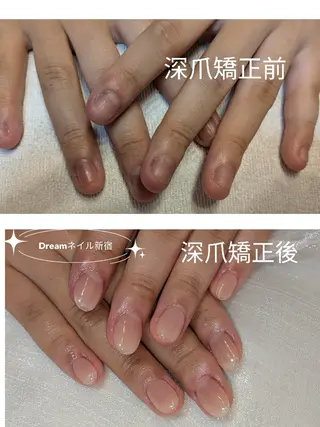 ネイル ネイリストゆか💅 長さだし、深爪矯正のネイルデザイン