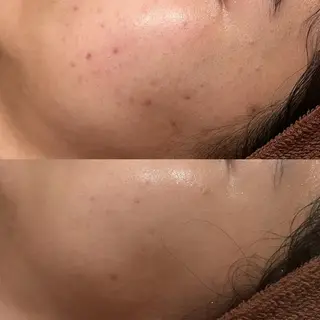 6万人の美肌実績🔥 最短ニキビ改善のエステ・リラクイメージ