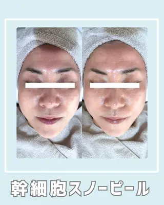 |ピーリング・毛穴| soina神楽坂のエステ・リラクイメージ