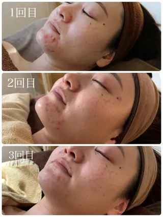 ハーブピーリング🌿 Vivaceのその他イメージ