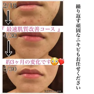 ミディアム パーマ ヘアアレンジ キッズ ネイル マツエク・マツパ ニキビ・肌質改善専門 ♡人生が変わるサロンのエステ・リラクイメージ