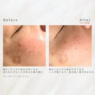 繰り返すニキビを改善 ✨つくば肌質改善専門のエステ・リラクイメージ