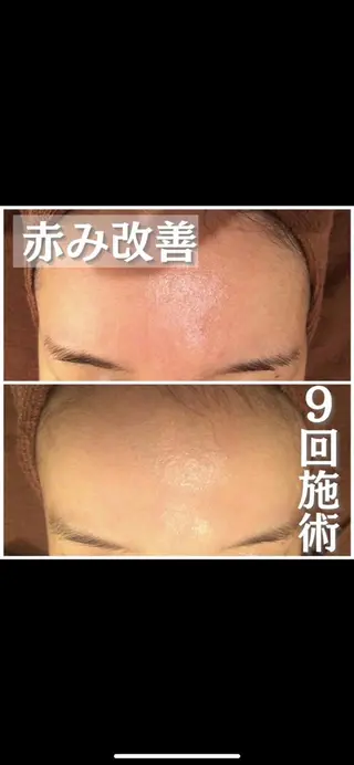 都内で出来る肌管理！ 最短ニキビ改善のエステ・リラクイメージ