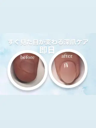 メンズ ネイル 爪ケア/深爪 自爪育成 🐰えむのネイルデザイン