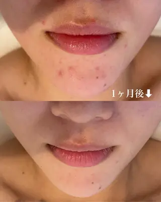 ハーブピーリング専門店lume(ルーム)所属・瀧野 史園のエステ・リラクイメージ