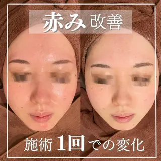 セミロング カラー パーマ ヘアアレンジ メンズ キッズ ネイル マツエク・マツパ アイブロウ ニキビ特化型エステ 🍓最短で肌質改善のエステ・リラクイメージ