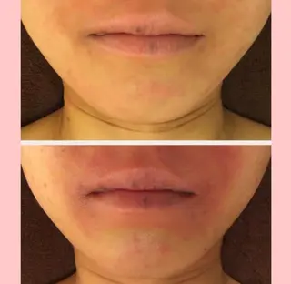 ニキビ特化型エステ 🍓最短で肌質改善のエステ・リラクイメージ