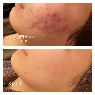 ミディアム ヘアアレンジ メンズ キッズ ネイル マツエク・マツパ ニキビ跡専門サロン Ａｉｎａのエステ・リラクイメージ