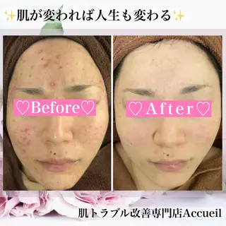 ニキビ・肌質改善専門 ♡人生が変わるサロンのエステ・リラクイメージ