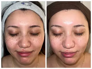 ハーブピーリング /毛穴ケア/脱毛/韓国ツヤ肌専門店【HARU.】所属・韓国ツヤ肌ピーリング ハーブ脱毛HARU.のエステ・リラクイメージ