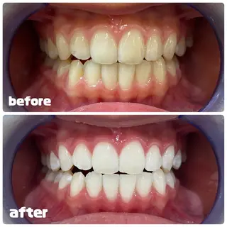 White Berry SELF BEAUTY SALON所属・セルフホワイトニング 🦷口元垢抜け✨のその他イメージ