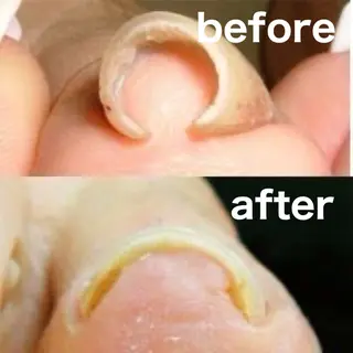 巻き爪フットケアサロンKotori所属・フットケアサロン Kotoriのその他イメージ