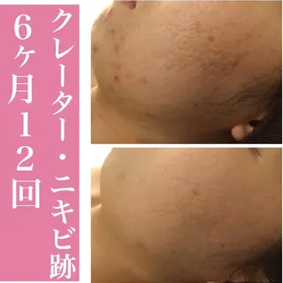 ロング カラー パーマ ヘアアレンジ メンズ キッズ ネイル マツエク・マツパ 都内で出来る肌管理！ 最短ニキビ改善のエステ・リラクイメージ