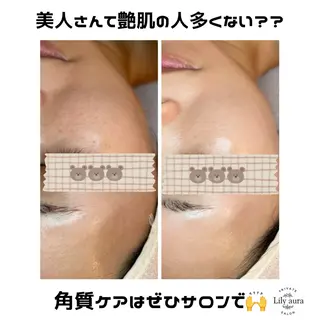 ニキビ/敏感肌/乾燥 Lilyauraのエステ・リラクイメージ