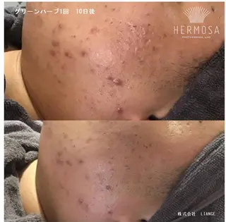 【ニキビ/肌管理】 salon varyのエステ・リラクイメージ