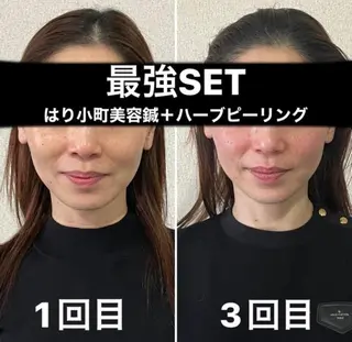 つばさ所属・マッツンの 鍼のその他イメージ