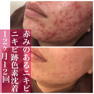 ミディアム カラー パーマ ヘアアレンジ メンズ キッズ ネイル マツエク・マツパ アイブロウ ニキビ・肌質改善専門 ♡人生が変わるサロンのエステ・リラクイメージ