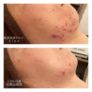 ミディアム カラー パーマ ヘアアレンジ メンズ キッズ ネイル マツエク・マツパ ニキビ跡専門サロン Ainaのエステ・リラクイメージ