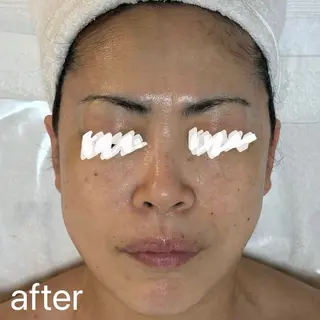 肌質改善|天王寺 For...はるかのエステ・リラクイメージ