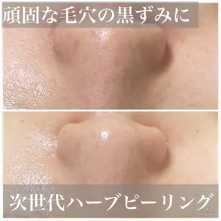 ニキビ・毛穴改善 🌿ハーブピーリングのエステ・リラクイメージ