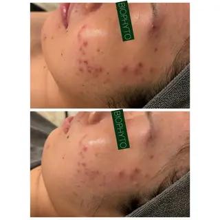 ☆痩身/小顔☆ ハイパーナイフexのエステ・リラクイメージ