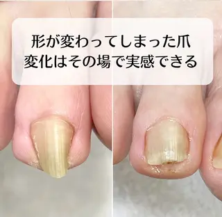 ネイル 深爪・巻き爪 専門サンセリテのネイルデザイン