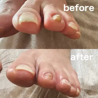 巻き爪フットケアサロンKotori所属・フットケアサロン Kotoriのその他イメージ