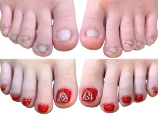 ネイル 深爪矯正・自爪育成 ネイルサロンアモまいのネイルデザイン
