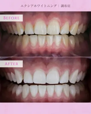 エクシアホワイト調布所属・umi❤︎ ホワイトニングのその他イメージ