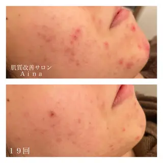 セミロング カラー パーマ ヘアアレンジ メンズ キッズ ネイル マツエク・マツパ ニキビ跡専門サロン Ainaのエステ・リラクイメージ