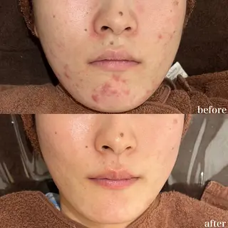 mieux所属・ハーブピーリング ¥6600のエステ・リラクイメージ