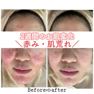 ロング カラー パーマ ヘアアレンジ メンズ キッズ ネイル マツエク・マツパ ニキビ&跡改善サロン オーナー光木のエステ・リラクイメージ