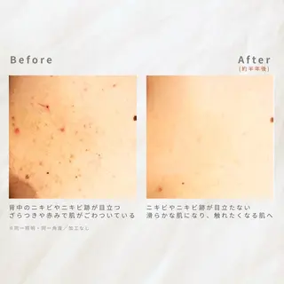 繰り返すニキビを改善 ✨つくば肌質改善専門のエステ・リラクイメージ