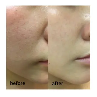 ハーブピーリング/韓国肌管理/フェイシャル/毛穴洗浄/眉毛/顔脱毛【糸脱毛専門】rev所属・ハーブピーリング🌹 毛穴洗浄❤️眉waxのエステ・リラクイメージ