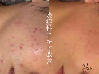 Flexi 表参道所属・🌟ニキビ・毛穴ケア 🌿Flexi表参道のエステ・リラクイメージ
