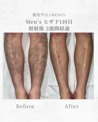 メンズ RESON 調布店所属・都度払いの脱毛サロン RESONのエステ・リラクイメージ