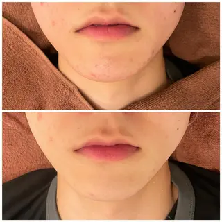 セミロング カラー パーマ ヘアアレンジ メンズ ネイル マツエク・マツパ アイブロウ ニキビ特化型エステ 🍓最短で肌質改善のエステ・リラクイメージ