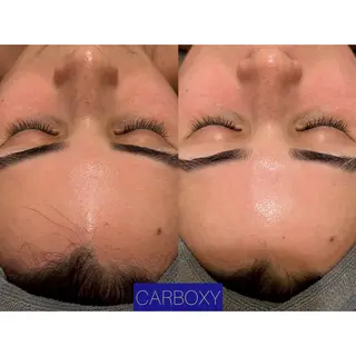 ☆痩身/小顔☆ ハイパーナイフexのエステ・リラクイメージ