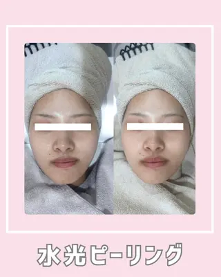 |ピーリング・毛穴| soina神楽坂のエステ・リラクイメージ