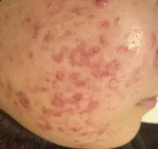 夏までに肌荒れ卒業 するサロン🌻のエステ・リラクイメージ