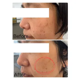 NARIS BEAUTY STATION　デ・アイム あべのルシアス所属・ニキビ跡/毛穴/ 肌質改善/北村ももこのエステ・リラクイメージ