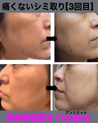 脱毛＆エステサロン【アンリミット】所属・森谷 莉美のエステ・リラクイメージ