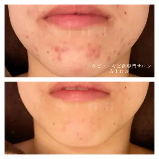 ニキビ跡専門サロン Ａｉｎａのエステ・リラクイメージ